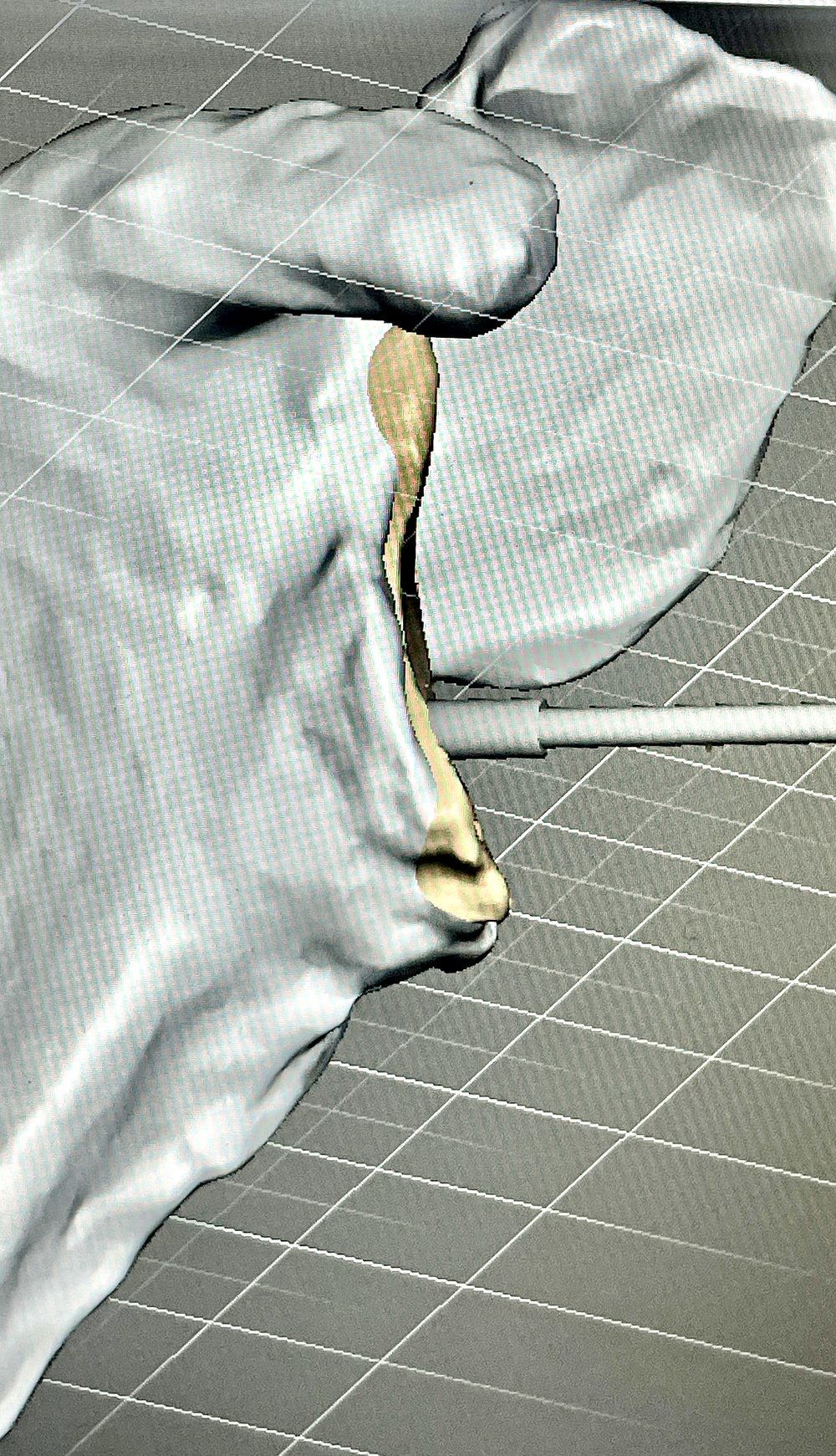 Implant being designed into a bone defect in CAD, against the patient's own reconstructed anatomy