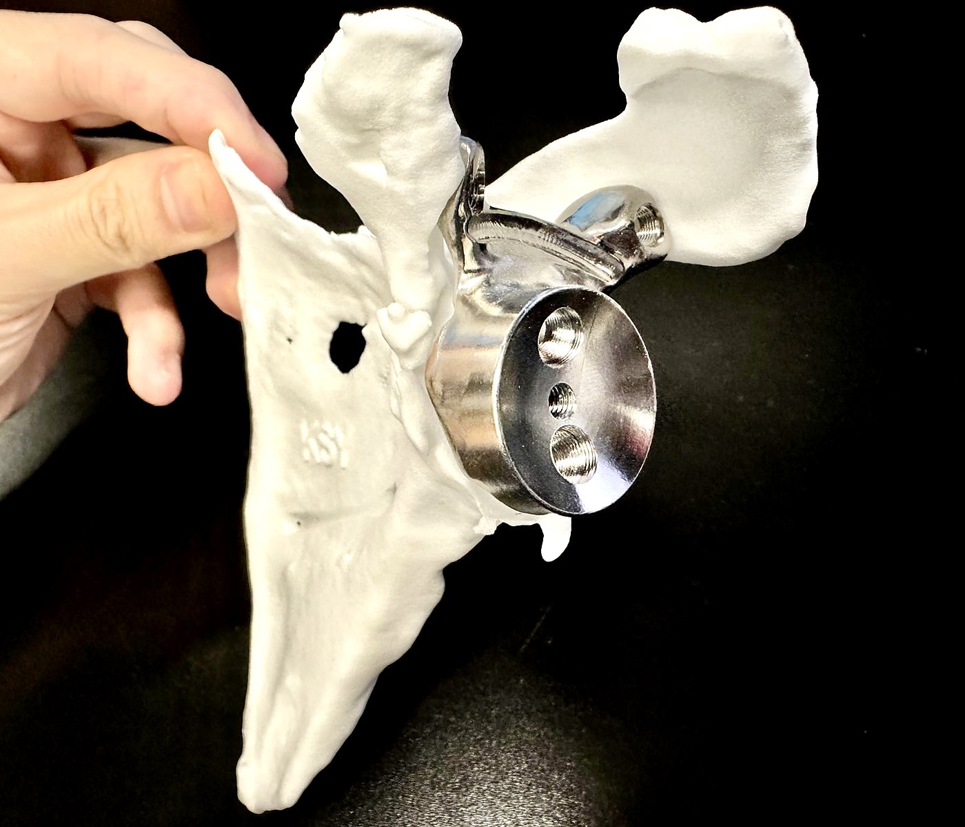 Finished custom acetabular implant fitted to a 3D-printed model of the patient's own pelvis