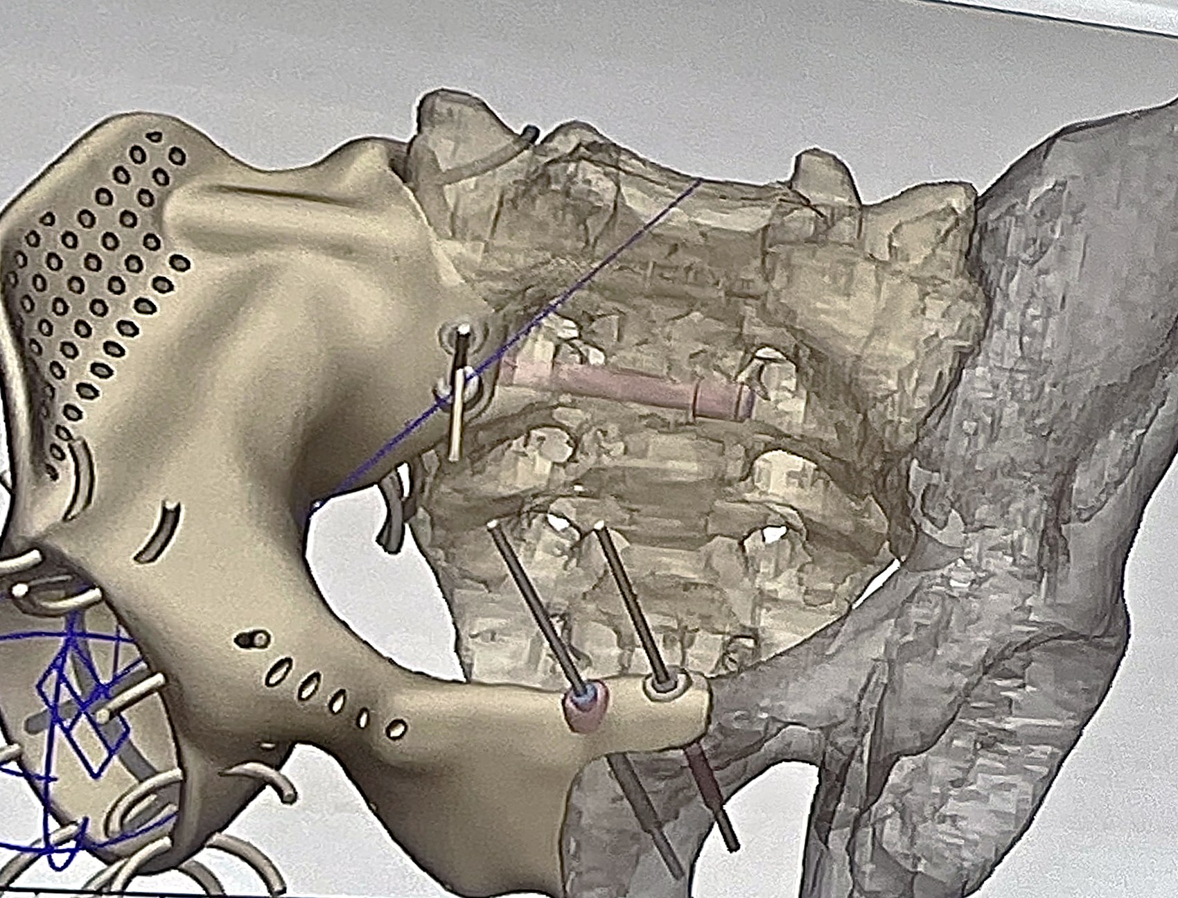 Design of a custom hemipelvis prosthesis against the remaining pelvic bone