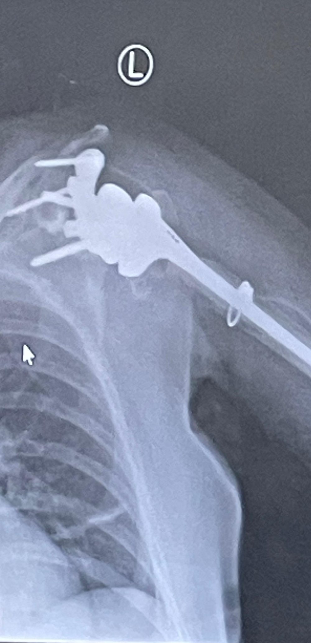 Post-operative X-ray of a shoulder reconstruction addressing massive glenoid and humeral bone loss