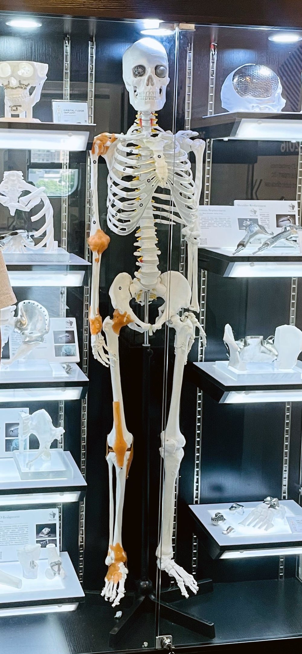 Display of 3D-printed implants for sites across the skeleton, including orbital floor, cranium, pelvis, shoulder and knee
