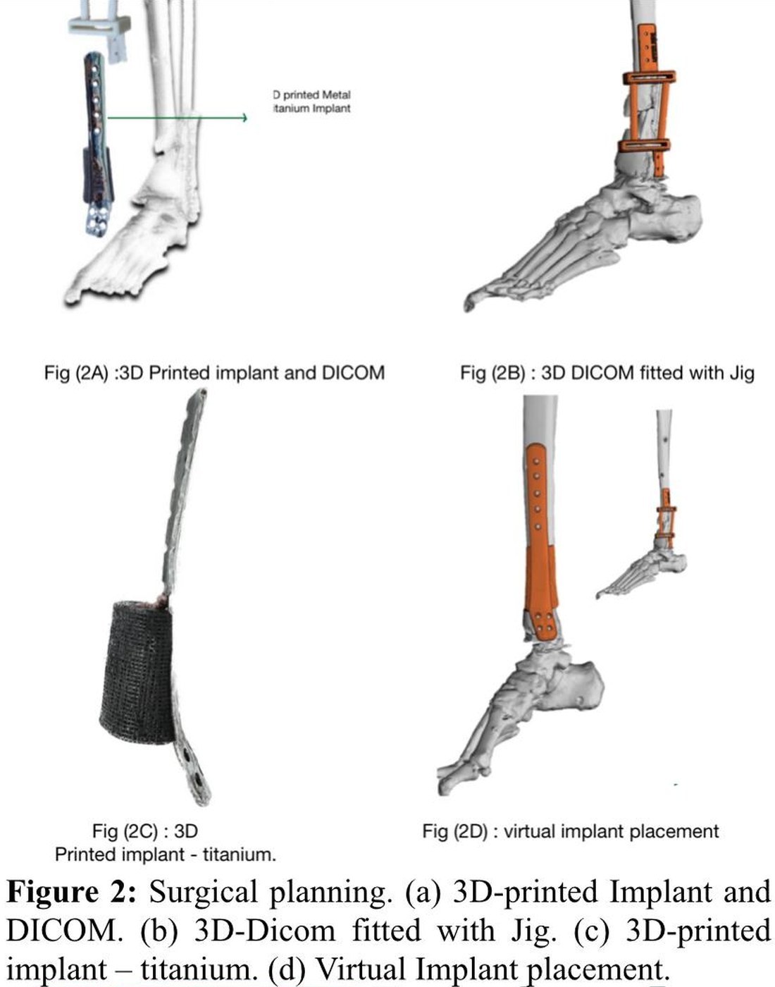 Published surgical planning figures: the 3D-printed titanium implant, the CT-derived model, the positioning jig and virtual implant placement