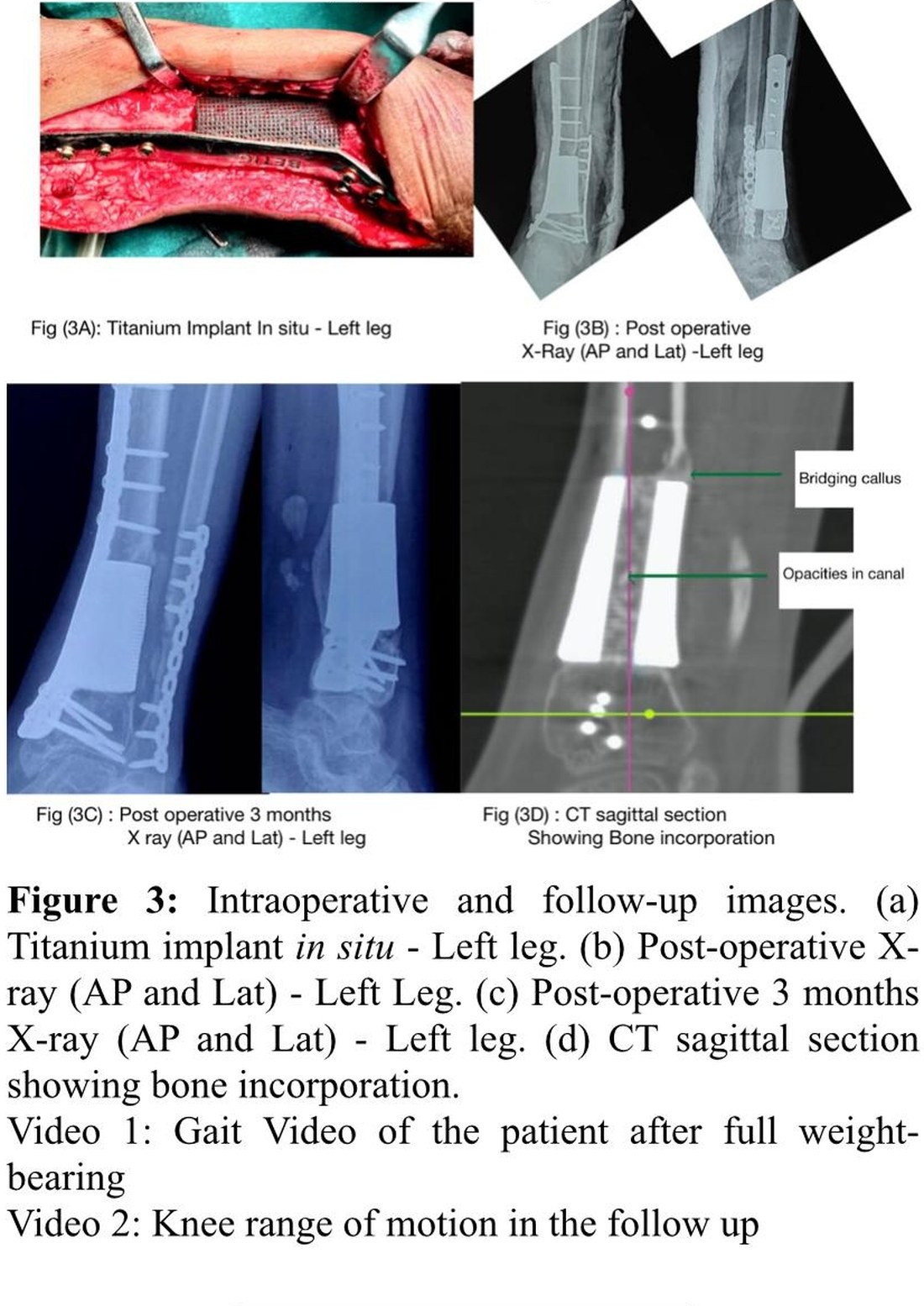 Published follow-up figures: the titanium implant in situ, post-operative X-rays, three-month films and a CT sagittal section showing bone incorporation