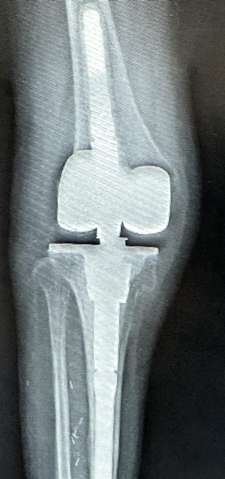 Radiograph of a revision total knee replacement with stemmed femoral and tibial components