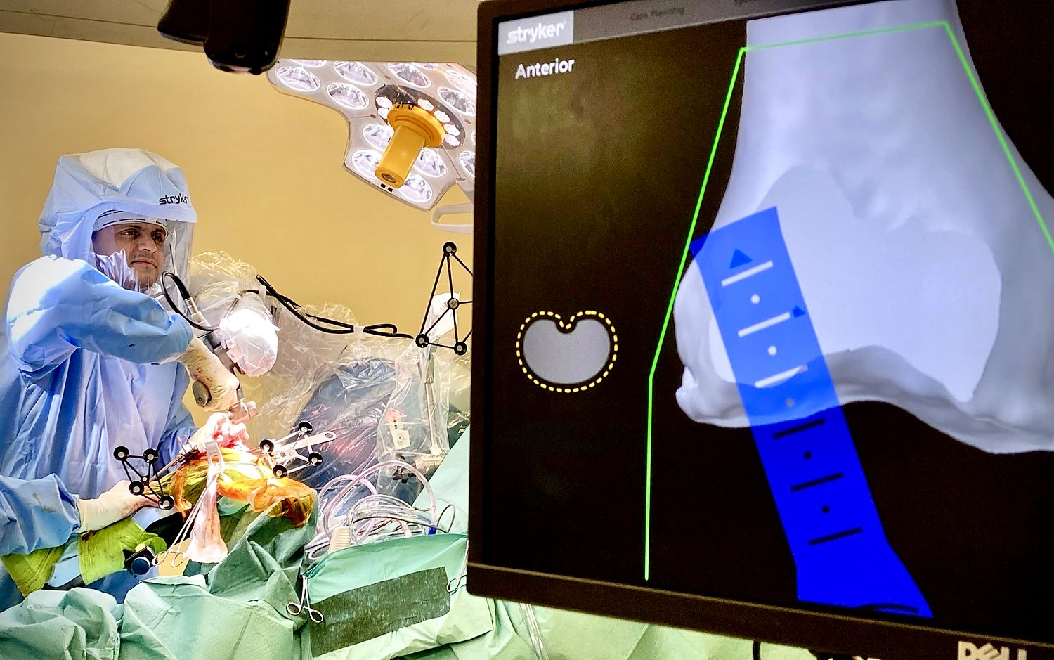 Dr. Avinash Kachare performing robotic-arm assisted knee replacement, with the navigation screen showing the planned bone cut